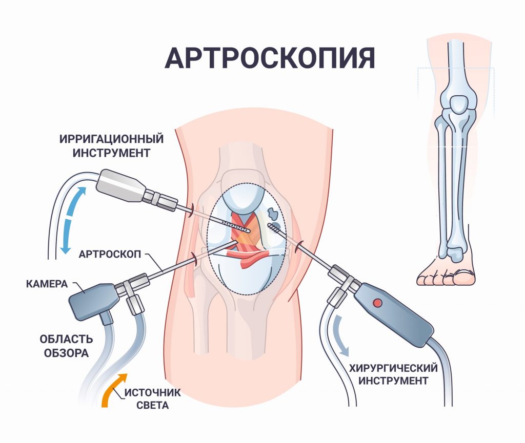 Операция артроскопия