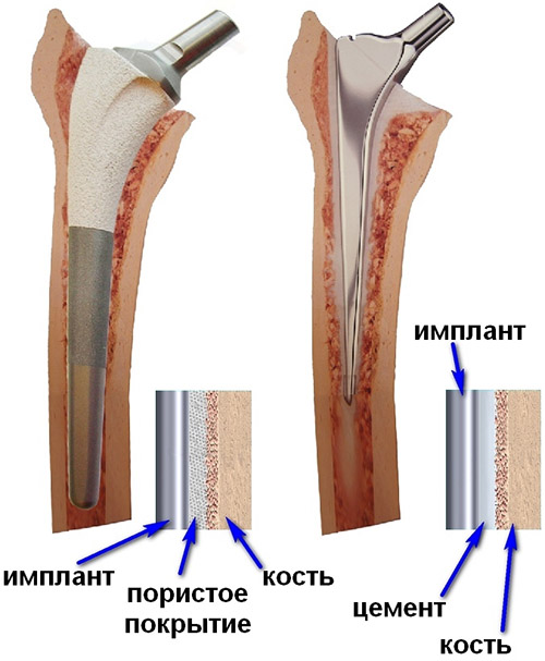 Цементное и безцементное крепление протеза