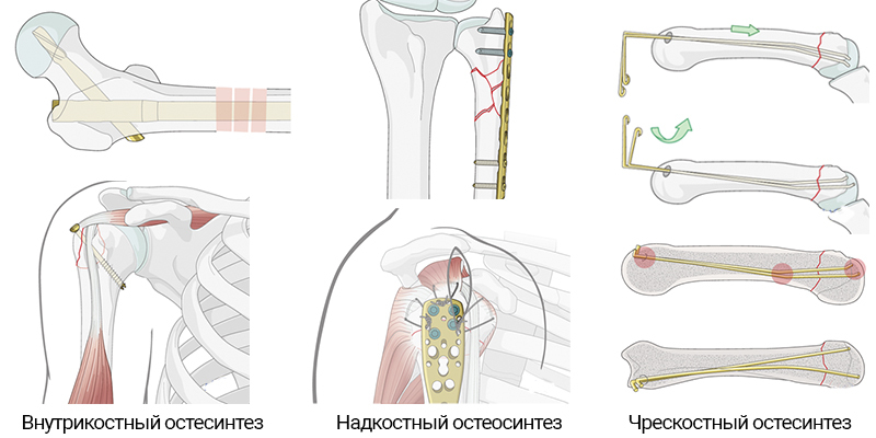 Виды остеосинтеза